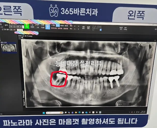 임플란트 치료 전 발치한 오른쪽 어금니 파노라마 엑스레이