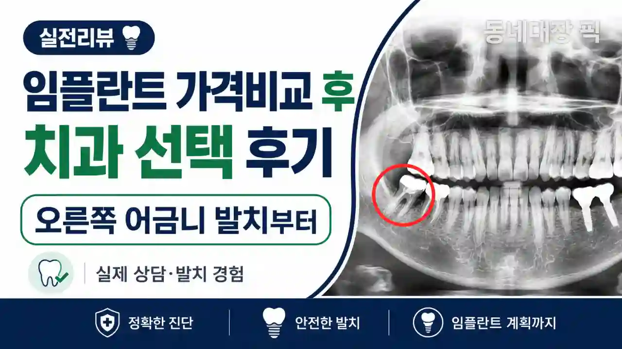 임플란트 가격비교 후 오른쪽 어금니 발치 후기